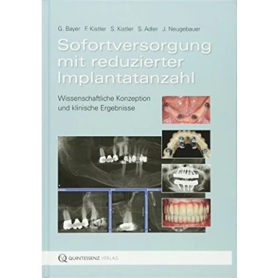 Abbildung von Sofortversorgung mit reduzierter Implantatanzahl: Wissenschaftliche Konzeption und klinische Ergebnisse