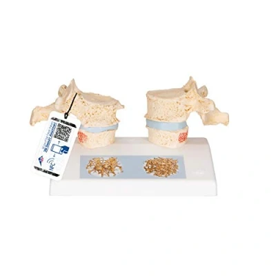 Abbildung von 3B Scientific Menschliche Anatomie Osteoporosemodell + kostenlose App Smart Anatomy