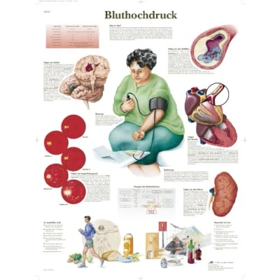 Abbildung von 3B Scientific Lehrtafel Bluthochdruck