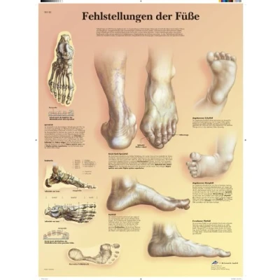 Abbildung von 3B Scientific Lehrtafel laminiert Fehlstellungen der Füße, VR0185L