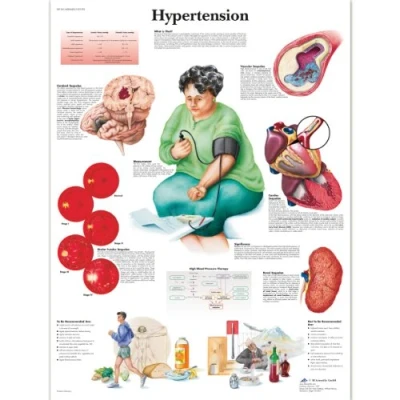 Abbildung von 3B Scientific Wissenschaftliche Anatomie des Menschen Hypertonie Diagramm, laminierte Version (Englische Version)