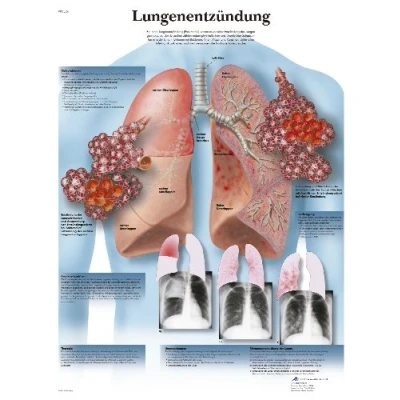 Abbildung von 3B Scientific Lehrtafel Lungenentzündung
