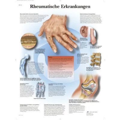 Abbildung von 3B Scientific Lehrtafel laminiert Rheumatische Erkrankungen
