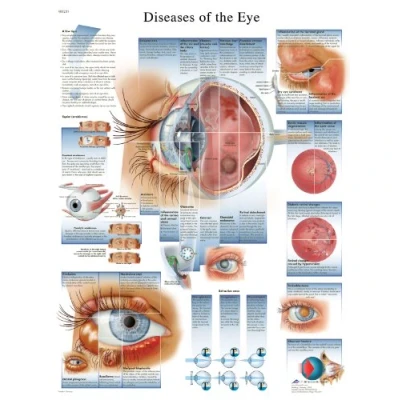 Abbildung von 3B Scientific Krankheiten Der Eye Diagramm L, laminated, 1
