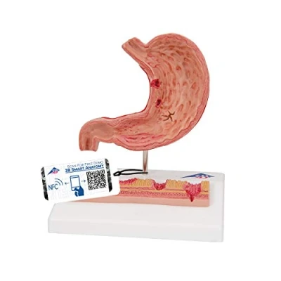 Abbildung von 3B Scientific Menschliche Anatomie Magen mit Magengeschwüren + kostenlose App Smart Anatomy