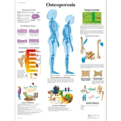 Abbildung von 3B Scientific Menschliche Anatomie Osteoporose Diagramm, laminierte Version