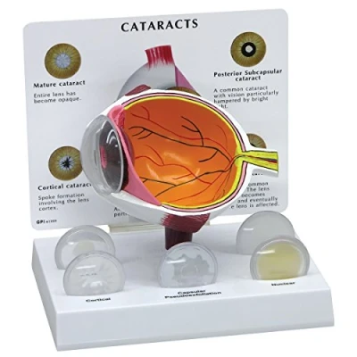 Abbildung von GPI Anatomicals W47852 Auge Modell Katarakt, grauer Star