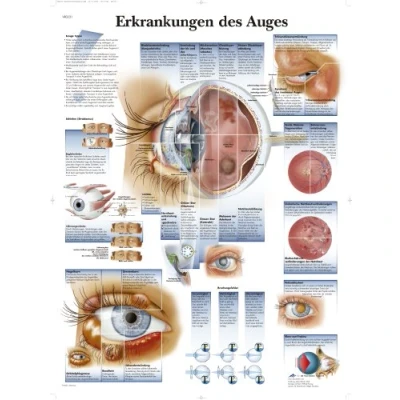 Abbildung von 3B Scientific Lehrtafel laminiert Erkrankungen des Auges
