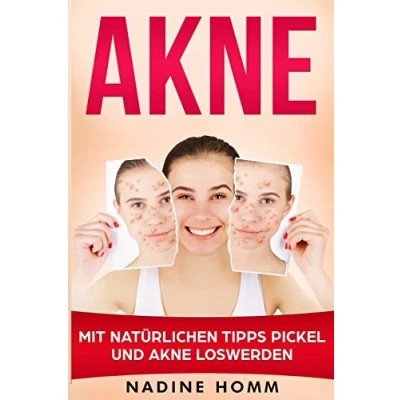 Abbildung von Akne: Mit natürlichen Tipps Pickel und Akne loswerden