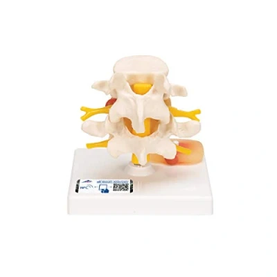 Abbildung von 3B Scientific Smart Anatomy Lendenwirbelsäule mit Bandscheibenvorfall + kostenlose Anatomie App