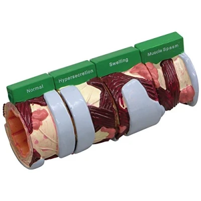 Abbildung von GPI Anatomicals W33362 Bronchie 4 Stadien Modell