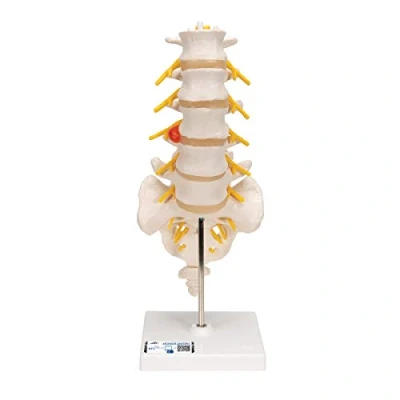 Abbildung von 3B Scientific Menschliche Anatomie Lendenwirbelsäule mit dorsolateralem Bandscheibenvorfall + kostenlose App Smart Anatomy