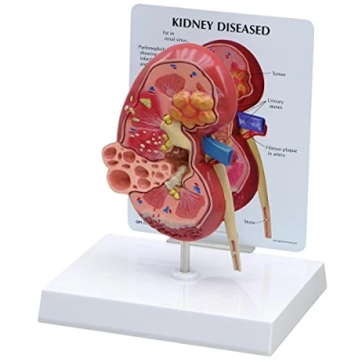 Abbildung von GPI Anatomicals 3260 Niere Modell normal mit Erkrankung