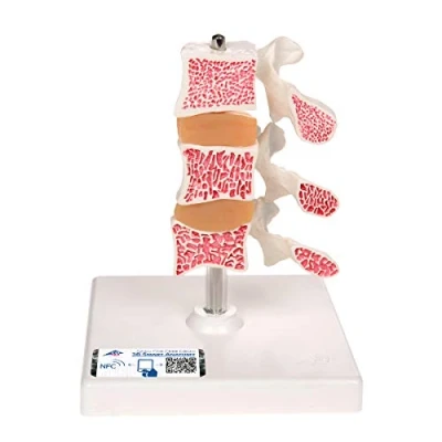 Abbildung von 3B Scientific Menschliche Anatomie Osteoporose Modell mit 3 Lendenwirbeln, auf Stativ + kostenlose App Smart Anatomy, Luxusmodell