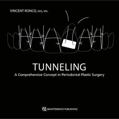 Abbildung von Tunneling: A Comprehensive Concept in Periodontal Plastic Surgery