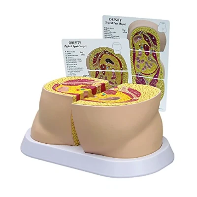 Abbildung von GPI Anatomicals W33363 Fettleibigkeit Modell