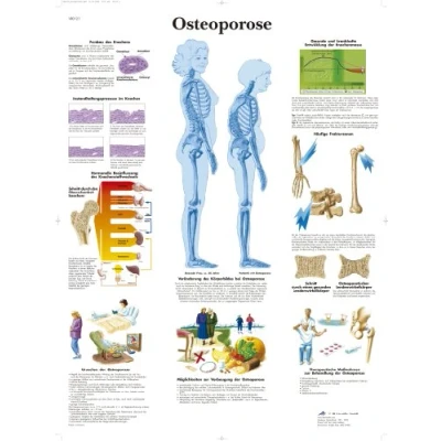 Abbildung von 3B Scientific Lehrtafel Osteoporose