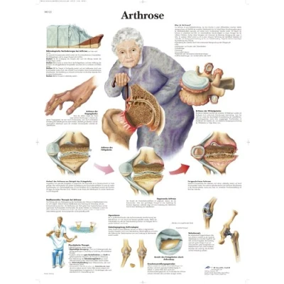 Abbildung von 3B Scientific Lehrtafel laminiert Arthrose